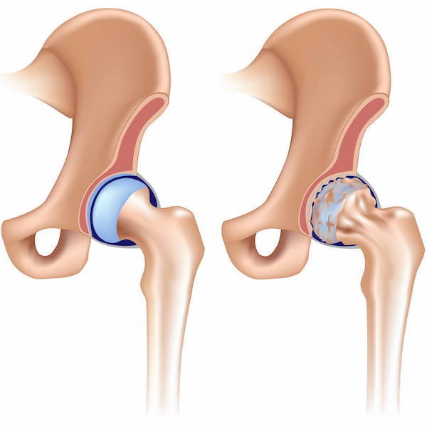 Arthrose-Hueftgelenk Arthrose am Hüftgelenk