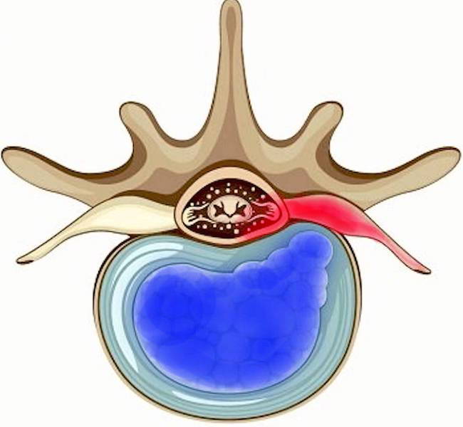 Bandscheibenprotrusion Bandscheibenprotrusion