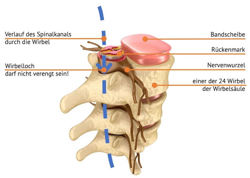 Spinalkanalstenose ERGOFIT Spinalkanalstenose ERGOFIT