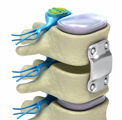 Spondylarthrose Versteifung Spondylarthrose Versteifung