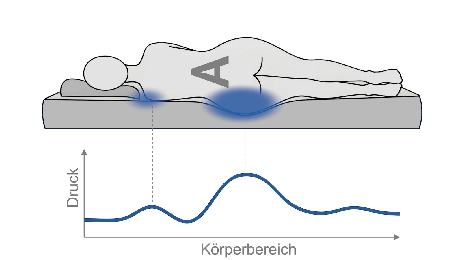 Körperform A mit erhöhter Druckbelastung im Beckenbereich in der Liegesituation